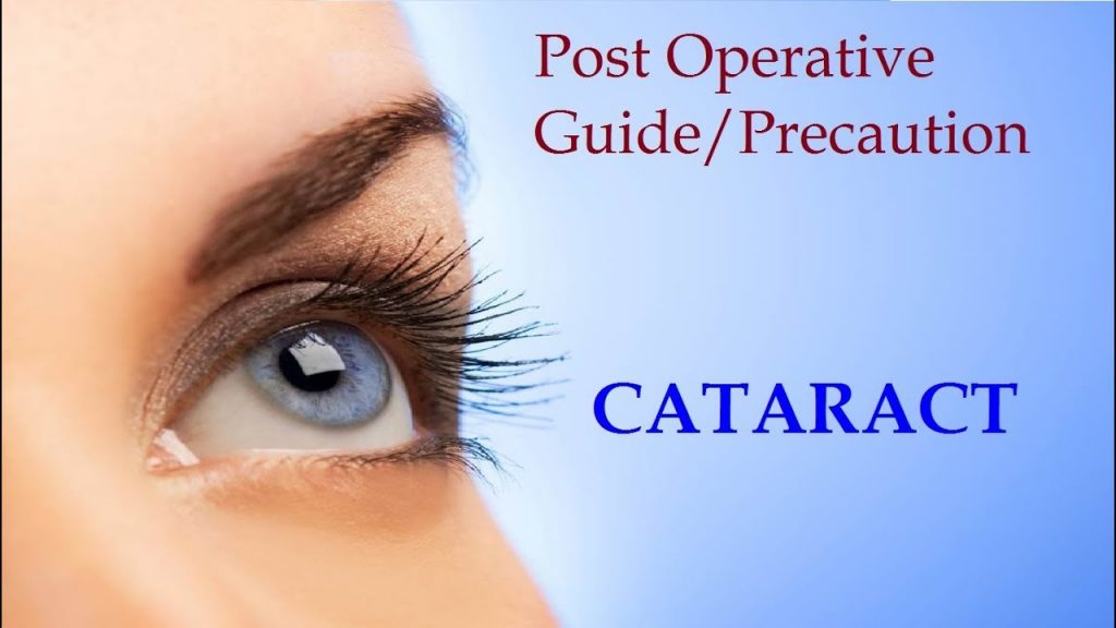 A Guide on What to Do After Cataract Eye Surgery